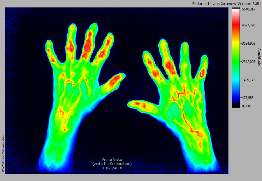 Rheumascan